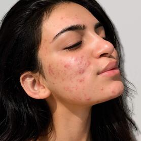 Serum cho da dầu mụn giúp sáng mịn, mờ thâm