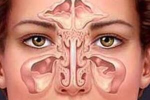 Viêm mũi xoang lâu năm, có thể trị dứt bằng thảo dược này