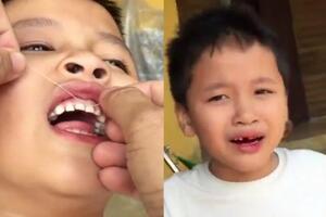 Bác sĩ nói gì về clip nhổ răng bá đạo nhất thế giới?