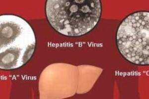 Các dạng viêm gan siêu vi thường gặp