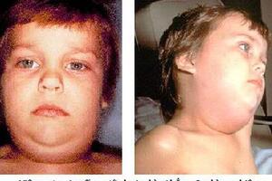 Bệnh quai bị ở trẻ emBệnh quai bị là bệnh truyền nhiễm, dễ lây lan và biến thành dịch. Trẻ em là đối tượng dễ mắc. Bệnh thường xuất hiện vào mùa đông xuân.