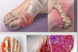 4 bài thuốc điều trị bệnh Gout hiệu quả