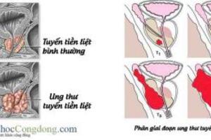 Ung thư tuyến tiền liệt