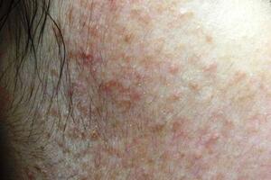 Hãi hùng mặt lở loét, mọc đầy lông vì dùng kem trộn chữa trứng cá, nám má