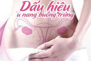 6 dấu hiệu u nang buồng trứng không phải ai cũng biết