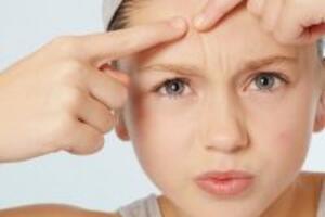 Mụn trứng cá tuổi dậy thì và cách chữa trị