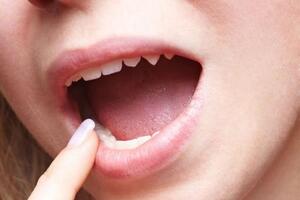 Ngoài âm đạo, các vùng này trên cơ thể cũng rất dễ bị nhiễm nấm men