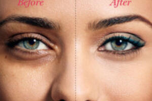 Cách làm hỗn hợp trị thâm quầng mắt sau 2 tuần