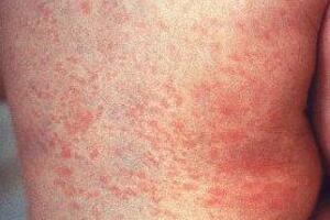 Ngứa phát ban do thời tiếtTriệu chứng: Nổi ban khắp người hoặc từng vùng. Ban đỏ. Thường tập trung ở vùng ngực cổ, 2 bả vai, 2 cánh tay. Ngứa nhiều. Bệnh nhân không sốt. Tiểu đỏ lượng ít. Phân thường bị táo.