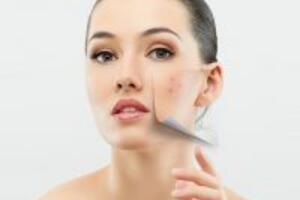 Cách trị mụn cho da dầu với giấm táo và bơ