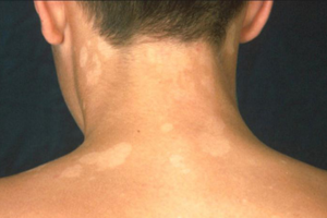 2 loại bệnh ngoài da thường gặp ở tuổi học sinh