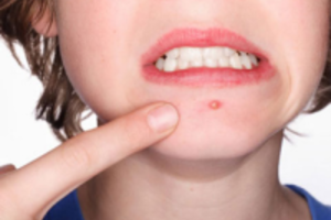 Những tác hại gây ra và cách trị mụn mủ đơn giản mà vô cùng hiệu quả