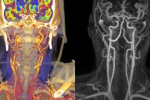 Chụp mạch máu não bằng CT hoặc MRI