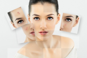 Sữa ong chúa tươi trị mụn hiệu quả