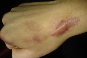 Bỏ túi các cách trị sẹo lồi hiệu quả