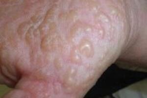 Các triệu chứng của bệnh chàm tổ đỉa