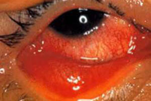 Bài thuốc chữa bệnh hay gặp mùa mưa