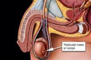 Dấu hiệu của bệnh ung thư tinh hoàn ở nam giới