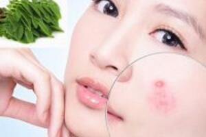 3 cách trị mụn từ cây chùm ngây