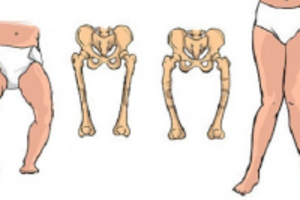 Trẻ thiếu canxi nguyên nhân do đâu và tác hại như thế nào?
