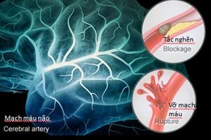 Ngăn ngừa và hỗ trợ phục hồi tai biến mạch máu não bằng nấm lim xanh