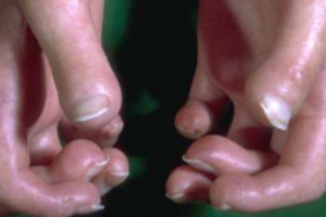 4 căn bệnh da liễu có thể nguy hiểm tới sức khỏe của bạn