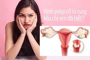 Polyp cổ tử cung - chị em nhất định phải biết