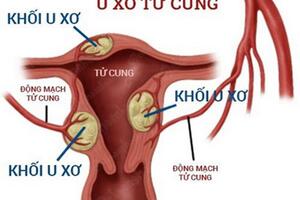 Dấu hiệu u xơ tử cung mà các chị em nhất định phải nắm rõ