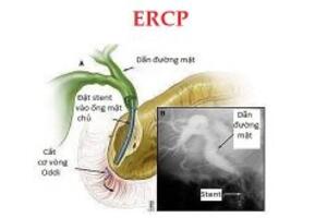 ERCP