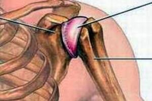 Bệnh thoái hóa khớp vai