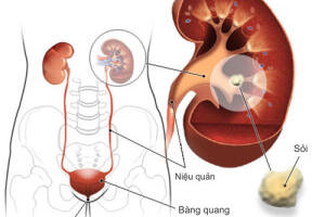 Bệnh gout và biến chứng suy thận