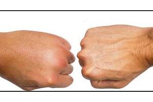 Ứ dịch hoặc phù nề trong quá trình điều trị ung thư