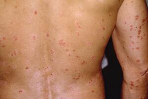 Những bệnh thường gặp vào mùa hè và cách phòng ngừa