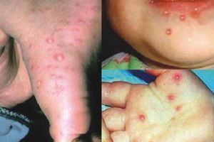 Con gặp nguy hiểm vì cha mẹ nhầm bệnh chân tay miệng với dị ứng da