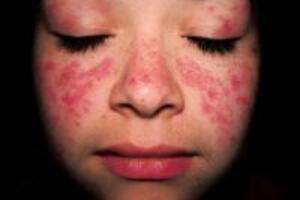Bệnh lupus ban đỏ nên ăn gì và kiêng những đồ ăn gì?