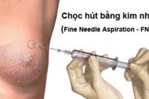 Chọc hút bằng kim nhỏ (FNA)