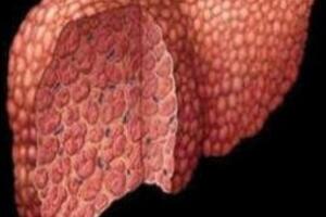 Xơ gan - Nguyên nhân, triệu chứng và các...