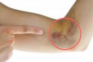 Dấu hiệu nhận biết bệnh tiểu đường sớm bạn nên đề phòng