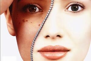 Sữa ong chúa trị nám da từ sâu bên trong