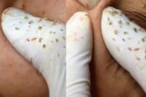 Sự hình thành và phát triển của mụn đầu đen đối với da mặt con người