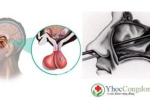 Tuyến yên và các loại u tuyến yên