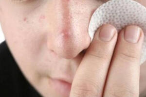 Các bài thuốc Đông y chữa mụn bọc nên tham khảo