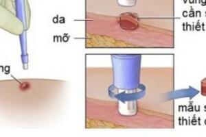 Sinh thiết (Biopsy)