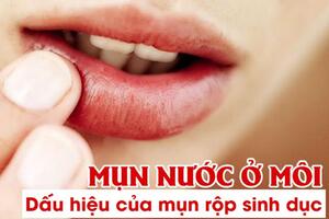 Mụn nước ở môi có phải dấu hiệu của bệnh mụn rộp sinh dục?
