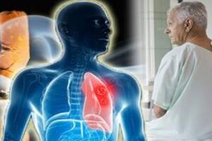 Điều trị Ung thư phổi tế bào nhỏ