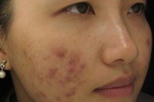 Tất tần tật các phương pháp trị thâm sau mụn trứng cá