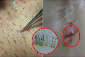 Không muốn nách thâm đen, bốc mùi, lại ung thư vú thì bạn cần BỎ ngay những thói quen này