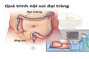 Nội soi ruột già dùng thuốc GoLytely®, NuLytely® hay CoLyte®