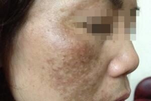 Phương pháp trị nám sai có thể gây ung thư