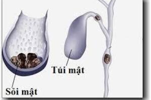 Ăn uống tránh sỏi mậtĂn nhiều rau, hoa quả, ăn cân đối khẩu phần, không nên ăn một loại thức ăn nhiều quá, cũng không nên quá kiêng khem. Khi bị bệnh sỏi mật cần đi khám và điều trị kịp thời.